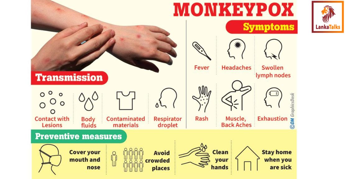 Sri Lanka braces for possible monkeypox threat